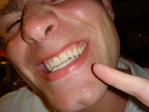 Chipped Tooth - Chipped Teeth