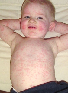 Kid Rashes - what they could mean
