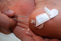 How to Remove a Splinter with Baking Soda - Household Tips