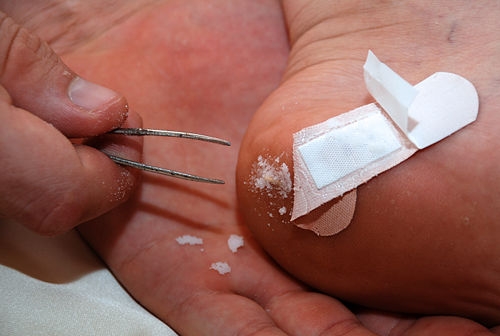 How to Remove a Splinter with Baking Soda